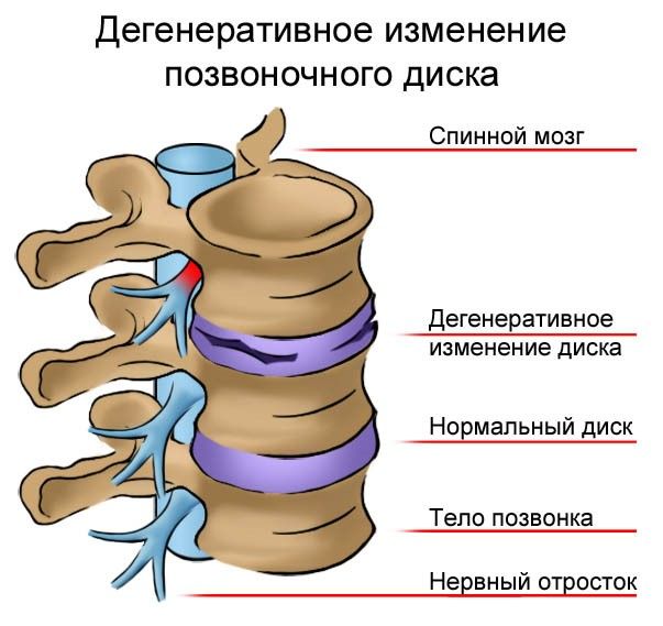 stadii-razvitiya-sheynogo-osteokhondroza