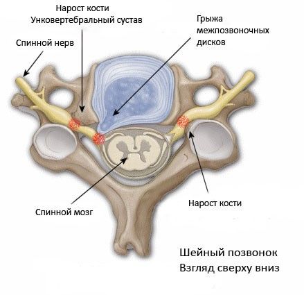 stadii-razvitiya-sheynogo-osteokhondroza3