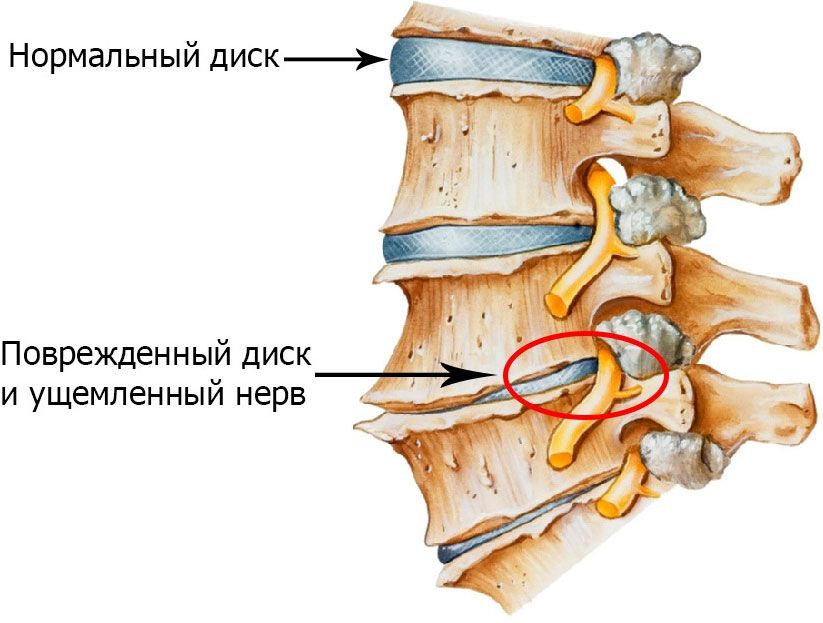 Шейно-грудной остеохондроз симптомы лечение и профилактика