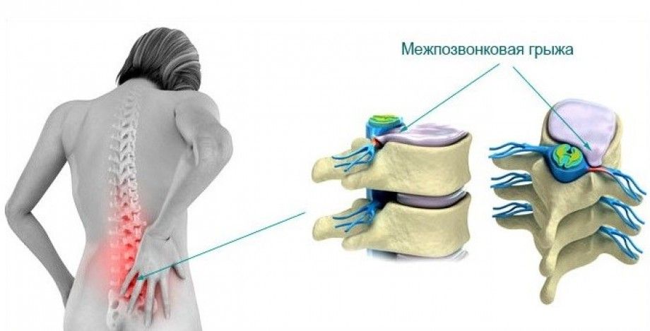 При вдохе и выдохе болит грудная клетка и спина