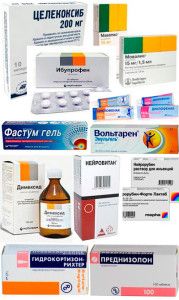 Виды аптечных препаратов для лечения лордоза