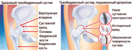 Здоровый и поражённый артритом тазобедренный сустав