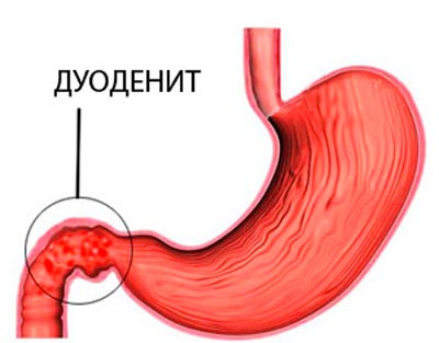 Чесотка у взрослых симптомы и лечение профилактика