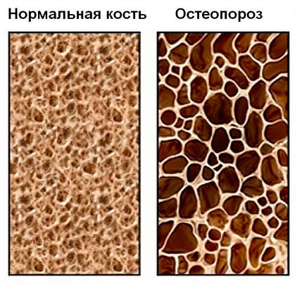 Нормальная плотность кости и остеопороз