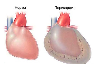 Сердце в норме и при заболевании перикардит