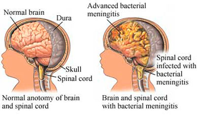 Нормальное и воспалённое (менингит) состояние головного мозга