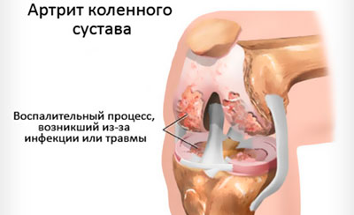Схема артрита коленного сустава, возникшего из-за инфекции или травмы