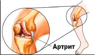 Артрит в разрезе коленного сустава