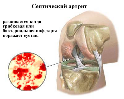 Инфекционный септический артрит