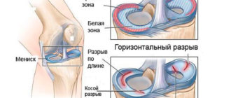 Типы разрыва мениска коленного сустава