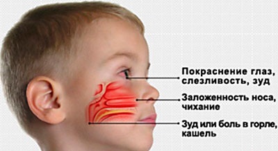Аллергический ринит у ребёнка
