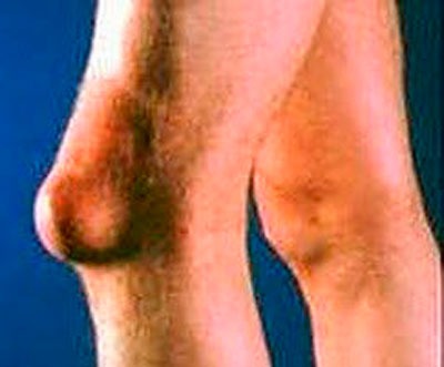 Бурсит коленного сустава