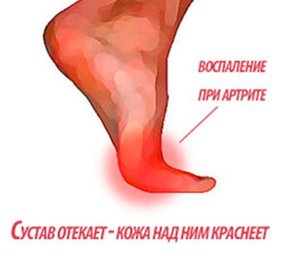 Артрит пальцев ног