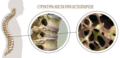 Остеопроз и кость
