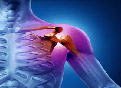 Причины и лечение невралгии плечевого нерва
