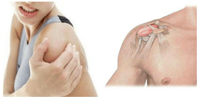 Причины и лечение невралгии плечевого нерва