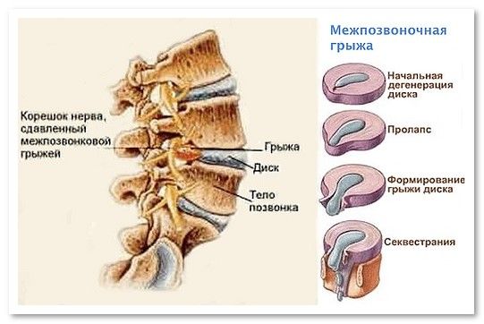 stadii-razvitiya-sheynogo-osteokhondroza2