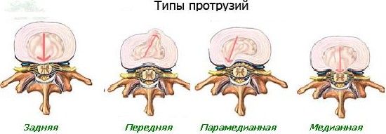 Протрузия шейного отдела с6 с7