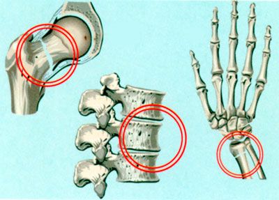 Переломы в суставах при остеопорозе и возникающие при этом боли