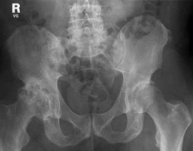 Изображение - Лечение остеопороза тазобедренного сустава у женщин simptomy-osteoartroza1-381x300