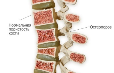 osteoporos