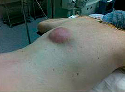 Ярко-выраженная опухоль при гемангиоме грудного отдела позвоночника