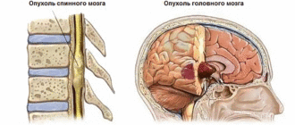 Опухоль спинного и головного мозга