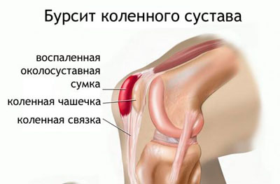 Бурсит коленного сустава