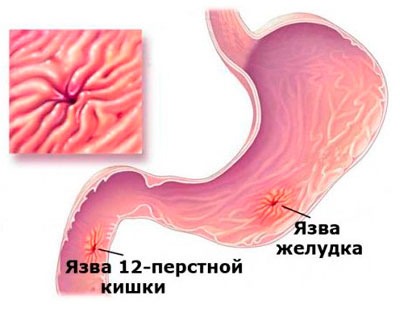 Язва 12-перстной кишки и желудка