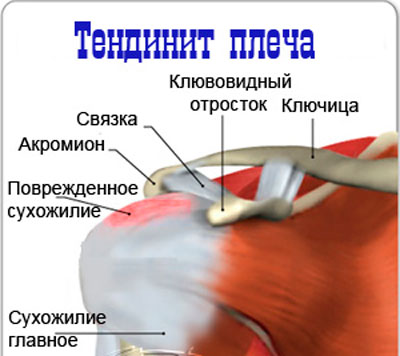 Изображение - Почему отнимается левая рука в плечевом суставе Tendenit-plecha