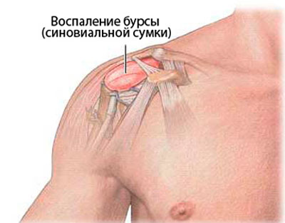 Изображение - Почему отнимается левая рука в плечевом суставе Vospalenie-bursy