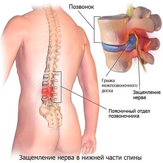 Защемление нерва в нижней части спины