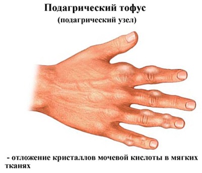 Подагра пальцев рук