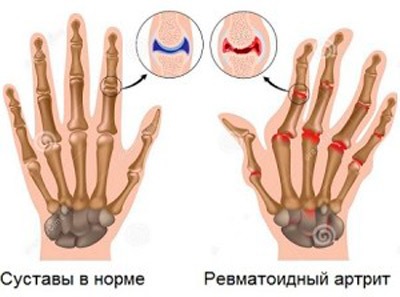 Ревматоидный артрит пальцев рук