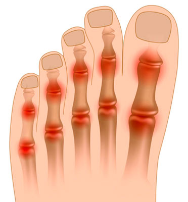 Боль в суставах пальцев ног