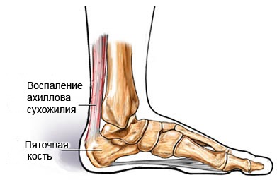 Народные средства лечения боли в голени ноги