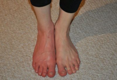 Почему болят ступни ног под пальцами