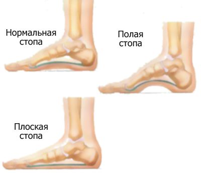 Болит под средним пальцем на ноге лечение