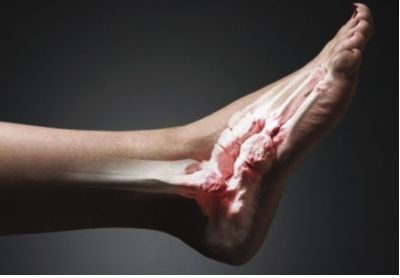 Болит стопа ног под пальцами