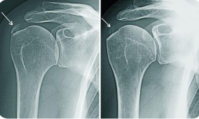 Изображение - Боли и хруст в плечевом суставе лечение Snimok-ekrana-2017-03-16-v-23.57.14