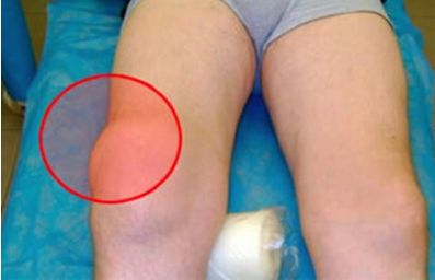 Боль в ногах ниже колена лечение в домашних условиях