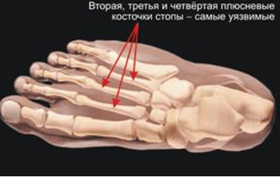Почему болят края большого пальца на ноге