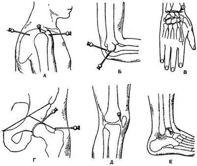Изображение - Блокада сустава ноги blokada-v-razlichnye-sustavy