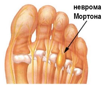 Болит большой палец ноги при движении