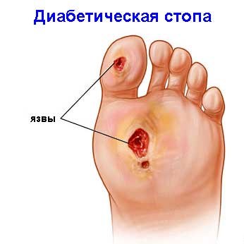 Болит нога над пальцами