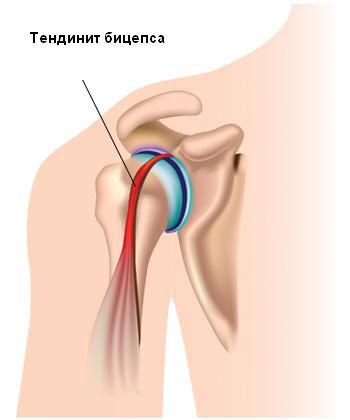 Изображение - Боли и хруст в плечевом суставе лечение tendinit-bicepsa1