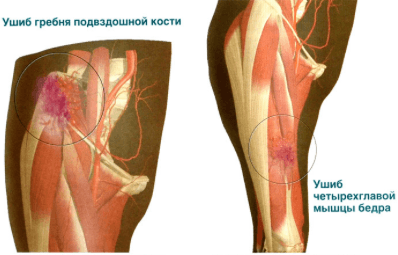 Боль в ягодице отдающая в ногу лечение уколы