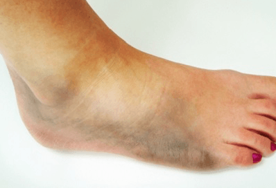 Изображение - Боли в суставах ступни ног лечение Snimok-ekrana-2017-04-05-v-18.44.10