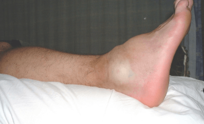 Изображение - Боли в суставах ступни ног лечение Snimok-ekrana-2017-04-05-v-18.44.33