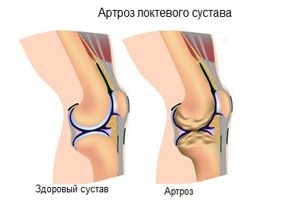 Болят задние мышцы ног в бедренной области больно сесть